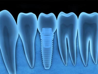 A tooth with a dental implant.