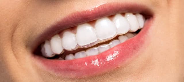 A close up of a woman's teeth undergoing tooth straightening in Lancashire.